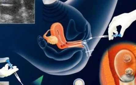 佛山试管婴儿的费用明细，花多少钱一目了然